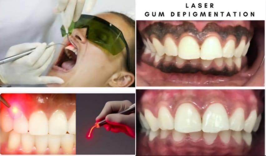 Laser dentistry procedure