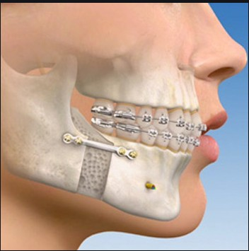 orthognathic surgery