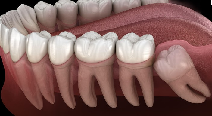 wisdom teeth