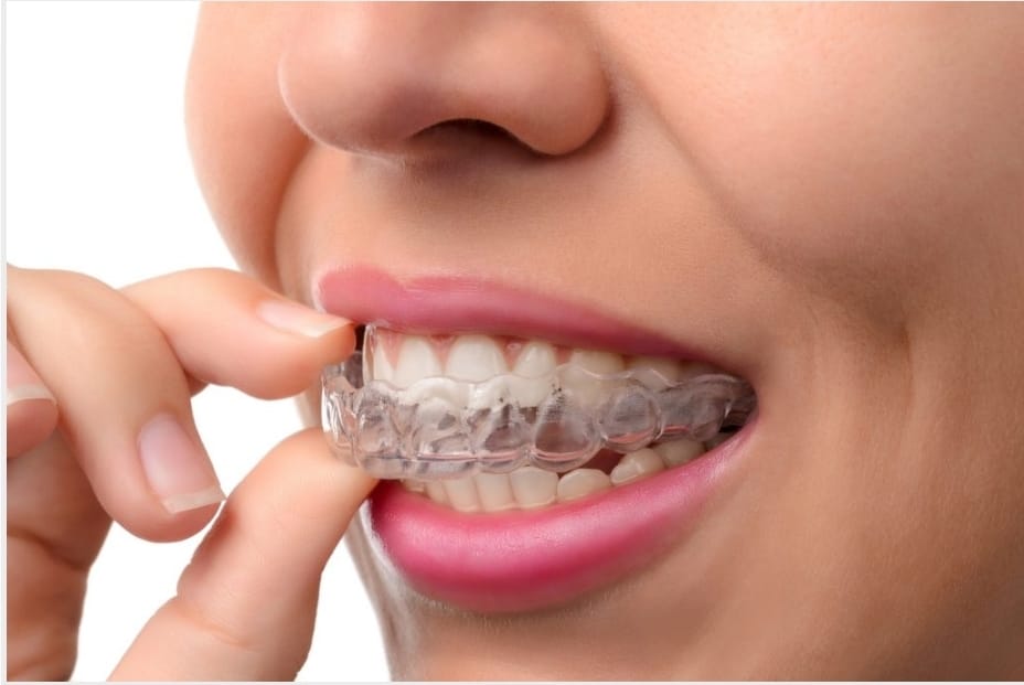 Patient wearing clear aligners