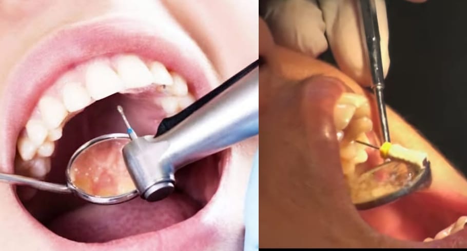 Root canal procedure illustration